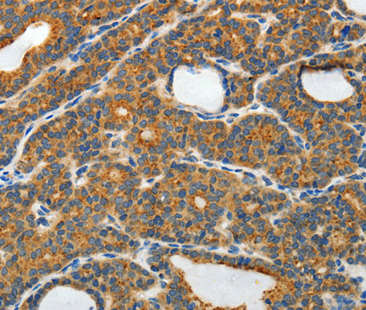 Immunohistochemistry of paraffin-embedded Human thyroid cancer tissue using RAMP3 Polyclonal Antibody at dilution 1:40