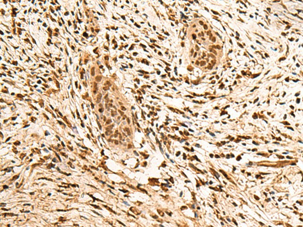 Immunohistochemistry of paraffin-embedded Human esophagus cancer tissue  using PPM1G Polyclonal Antibody at dilution of 1:40(?200)