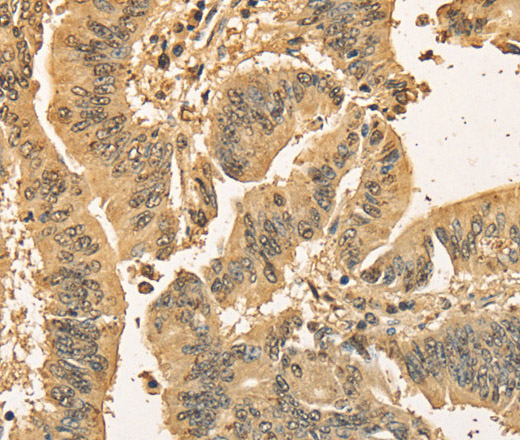 Immunohistochemistry of paraffin-embedded Human colon cancer using CDCA8 Polyclonal Antibody at dilution of 1:40