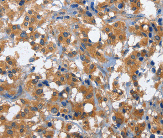 Immunohistochemistry of paraffin-embedded Human thyroid cancer using CD27 Polyclonal Antibody at dilution of 1:60