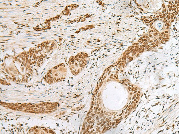 Immunohistochemistry of paraffin-embedded Human esophagus cancer tissue  using PNRC2 Polyclonal Antibody at dilution of 1:30(?200)