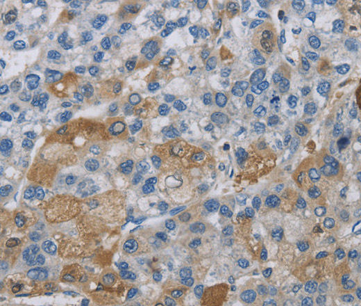 Immunohistochemistry of paraffin-embedded Human liver cancer using DNAJB4 Polyclonal Antibody at dilution of 1:50