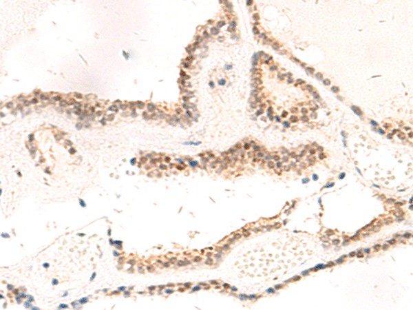 Immunohistochemistry of paraffin-embedded Human thyroid cancer tissue  using RPL13A Polyclonal Antibody at dilution of 1:95(?200)