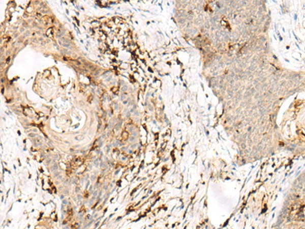 Immunohistochemistry of paraffin-embedded Human esophagus cancer tissue  using OVOL2 Polyclonal Antibody at dilution of 1:50(?200)