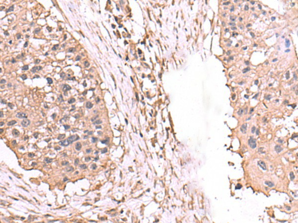 Immunohistochemistry of paraffin-embedded Human esophagus cancer tissue  using AHCYL1 Polyclonal Antibody at dilution of 1:65(?200)