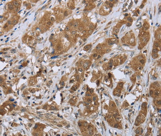 Immunohistochemistry of paraffin-embedded Human breast cancer tissue using CLPS Polyclonal Antibody at dilution 1:45