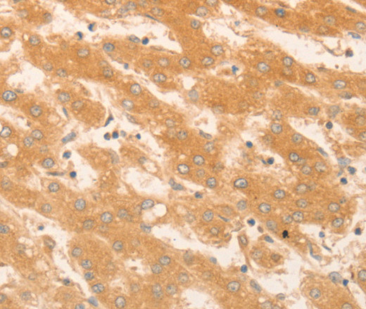 Immunohistochemistry of paraffin-embedded Human liver cancer using NAP1L1 Polyclonal Antibody at dilution of 1:50