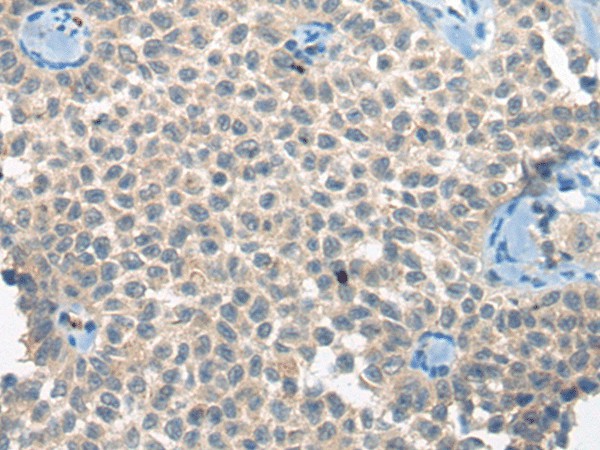 Immunohistochemistry of paraffin-embedded Human ovarian cancer tissue  using CLTCL1 Polyclonal Antibody at dilution of 1:60(?200)