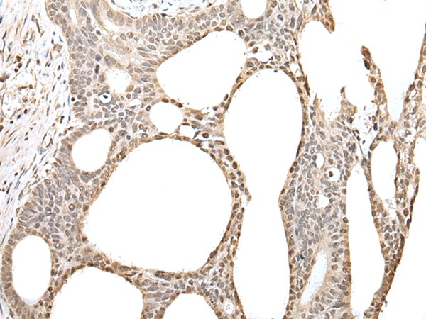 Immunohistochemistry of paraffin-embedded Human gastric cancer tissue  using ZBTB5 Polyclonal Antibody at dilution of 1:40(?200)