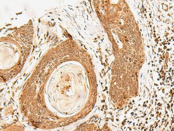 Immunohistochemistry of paraffin-embedded Human esophagus cancer tissue  using POLH Polyclonal Antibody at dilution of 1:60(?200)