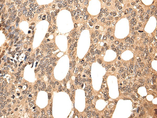 Immunohistochemistry of paraffin-embedded Human colorectal cancer tissue  using ATF7 Polyclonal Antibody at dilution of 1:40(?200)