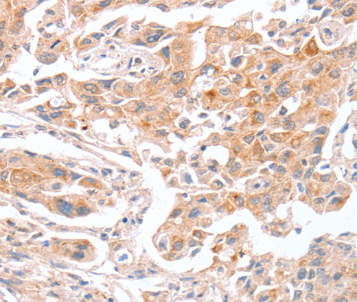 Immunohistochemistry of paraffin-embedded Human lung cancer tissue using ABO Polyclonal Antibody at dilution 1:50