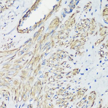 Immunohistochemistry of paraffin-embedded Human uterine cancer using FLNA Polyclonal Antibody at dilution of 1:100 (40x lens).