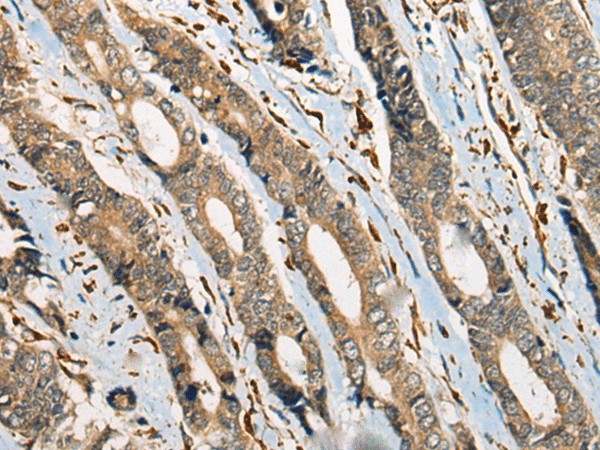 Immunohistochemistry of paraffin-embedded Human gastric cancer tissue  using ODF2 Polyclonal Antibody at dilution of 1:110(?200)