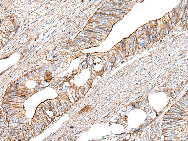 Immunohistochemistry of paraffin-embedded Human colorectal cancer tissue  using BLVRB Polyclonal Antibody at dilution of 1:65(?200)