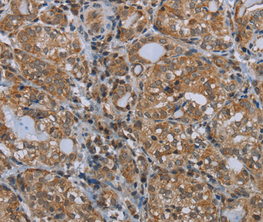 Immunohistochemistry of paraffin-embedded Human thyroid cancer tissue using MARK1 Polyclonal Antibody at dilution 1:30