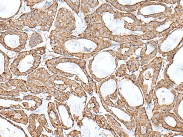 Immunohistochemistry of paraffin-embedded Human thyroid cancer tissue  using RNF111 Polyclonal Antibody at dilution of 1:50(?200)