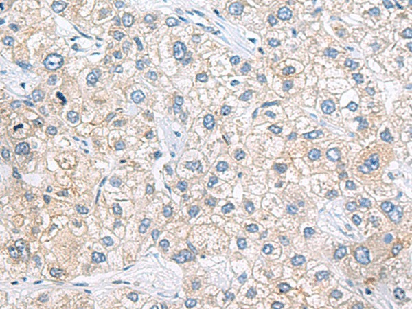 Immunohistochemistry of paraffin-embedded Human liver cancer tissue  using ZNF35 Polyclonal Antibody at dilution of 1:40(?200)