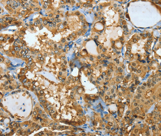 Immunohistochemistry of paraffin-embedded Human thyroid cancer using ANXA3 Polyclonal Antibody at dilution of 1:35