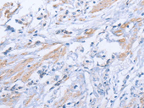 Immunohistochemistry of paraffin-embedded Human prost at e cancer tissue  using ZBTB1  Polyclonal Antibody at dilution of 1:50(?200)