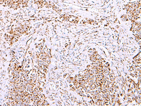 Immunohistochemistry of paraffin-embedded Human ovarian cancer tissue  using HSF2BP Polyclonal Antibody at dilution of 1:30(?200)