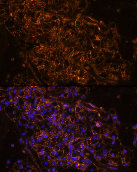 Immunofluorescence analysis of Human kidney cancer using SCNN1G Polyclonal Antibody at dilution of 1:100. Blue: DAPI for nuclear staining.