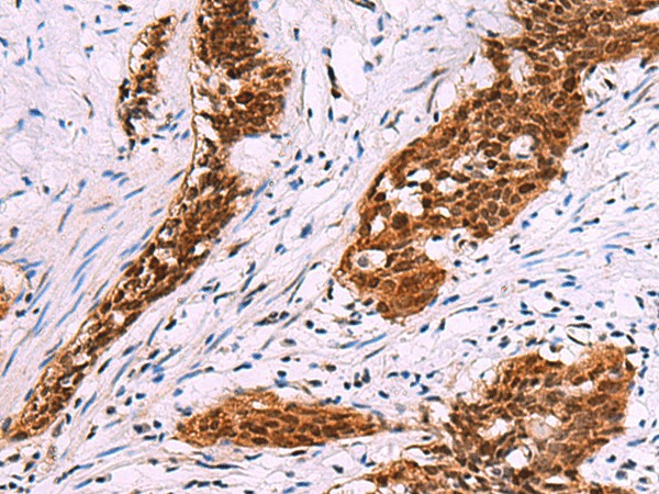 Immunohistochemistry of paraffin-embedded Human esophagus cancer tissue  using FKBP4 Polyclonal Antibody at dilution of 1:50(?200)