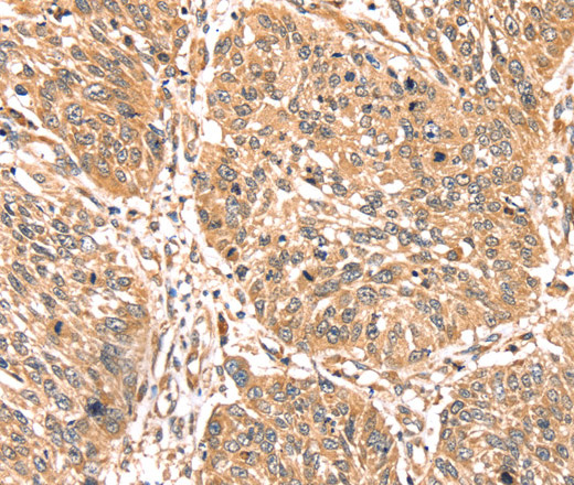 Immunohistochemistry of paraffin-embedded Human lung cancer using PDLIM4 Polyclonal Antibody at dilution of 1:40