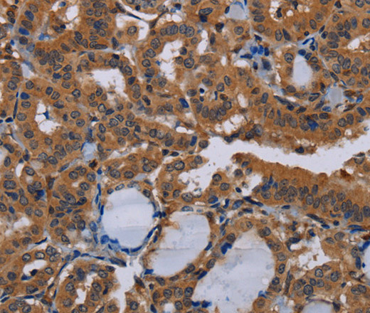 Immunohistochemistry of paraffin-embedded Human thyroid cancer tissue using NPTX1 Polyclonal Antibody at dilution 1:50