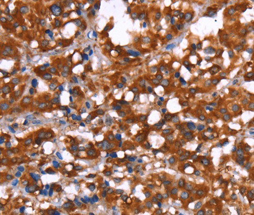 Immunohistochemistry of paraffin-embedded Human thyroid cancer tissue using GAGE12I Polyclonal Antibody at dilution 1:30