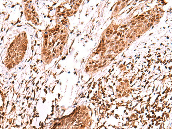 Immunohistochemistry of paraffin-embedded Human esophagus cancer tissue  using AK9 Polyclonal Antibody at dilution of 1:60(?200)