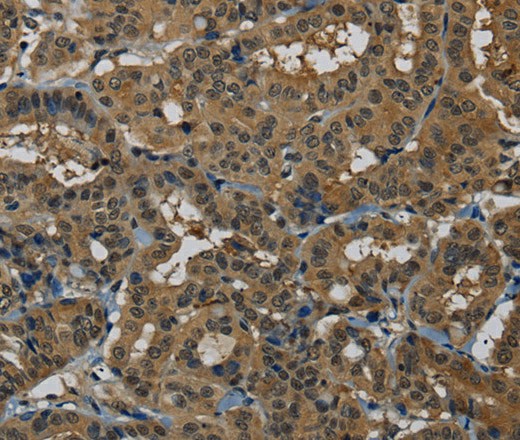 Immunohistochemistry of paraffin-embedded Human thyroid cancer tissue using PNN Polyclonal Antibody at dilution 1:50