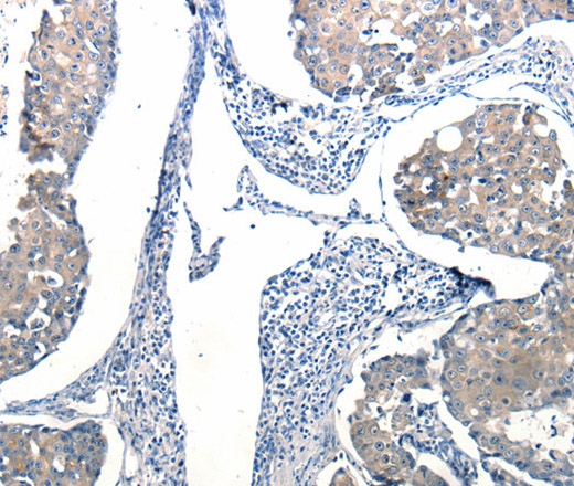 Immunohistochemistry of paraffin-embedded Human breast cancer tissue using Ccl6 Polyclonal Antibody at dilution 1:50