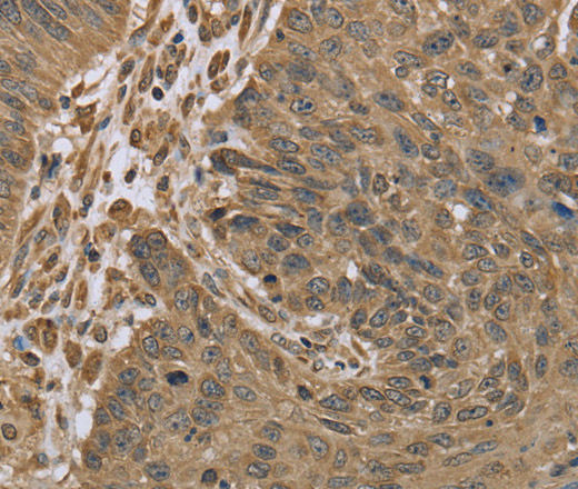 Immunohistochemistry of paraffin-embedded Human lung cancer tissue using IKBIP Polyclonal Antibody at dilution 1:30