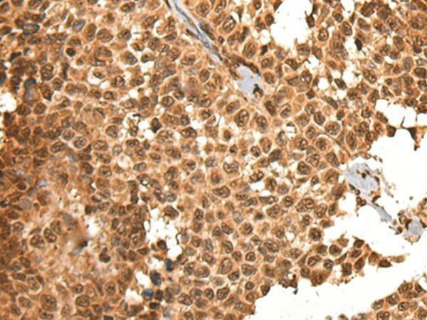 Immunohistochemistry of paraffin-embedded Human ovarian cancer tissue  using BRSK1 Polyclonal Antibody at dilution of 1:95(?200)