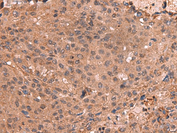 Immunohistochemistry of paraffin-embedded Human colorectal cancer tissue  using IST1 Polyclonal Antibody at dilution of 1:40(?200)