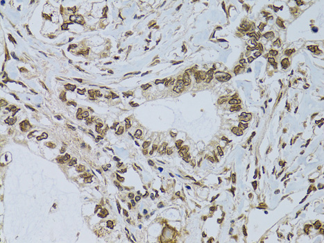 Immunohistochemistry of paraffin-embedded Human gastric cancer using EMD Polyclonal Antibody at dilution of  1:100 (40x lens).