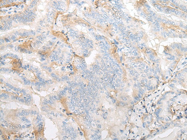 Immunohistochemistry of paraffin-embedded Human thyroid cancer tissue  using TMEM248 Polyclonal Antibody at dilution of 1:25(?200)