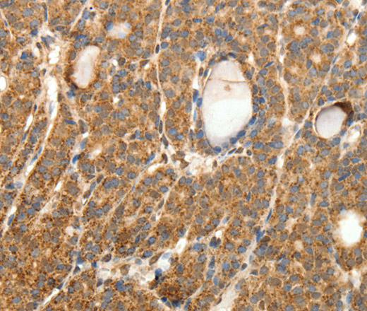 Immunohistochemistry of paraffin-embedded Human thyroid cancer tissue using SYT11 Polyclonal Antibody at dilution 1:30