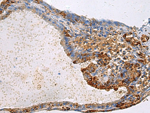 Immunohistochemistry of paraffin-embedded Human thyroid cancer tissue  using GNAI1 Polyclonal Antibody at dilution of 1:100(?200)