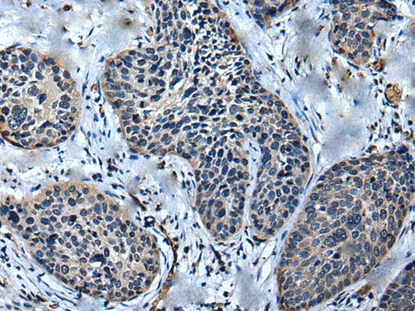 Immunohistochemistry of paraffin-embedded Human cervical cancer tissue  using ULK4 Polyclonal Antibody at dilution of 1:75(?200)