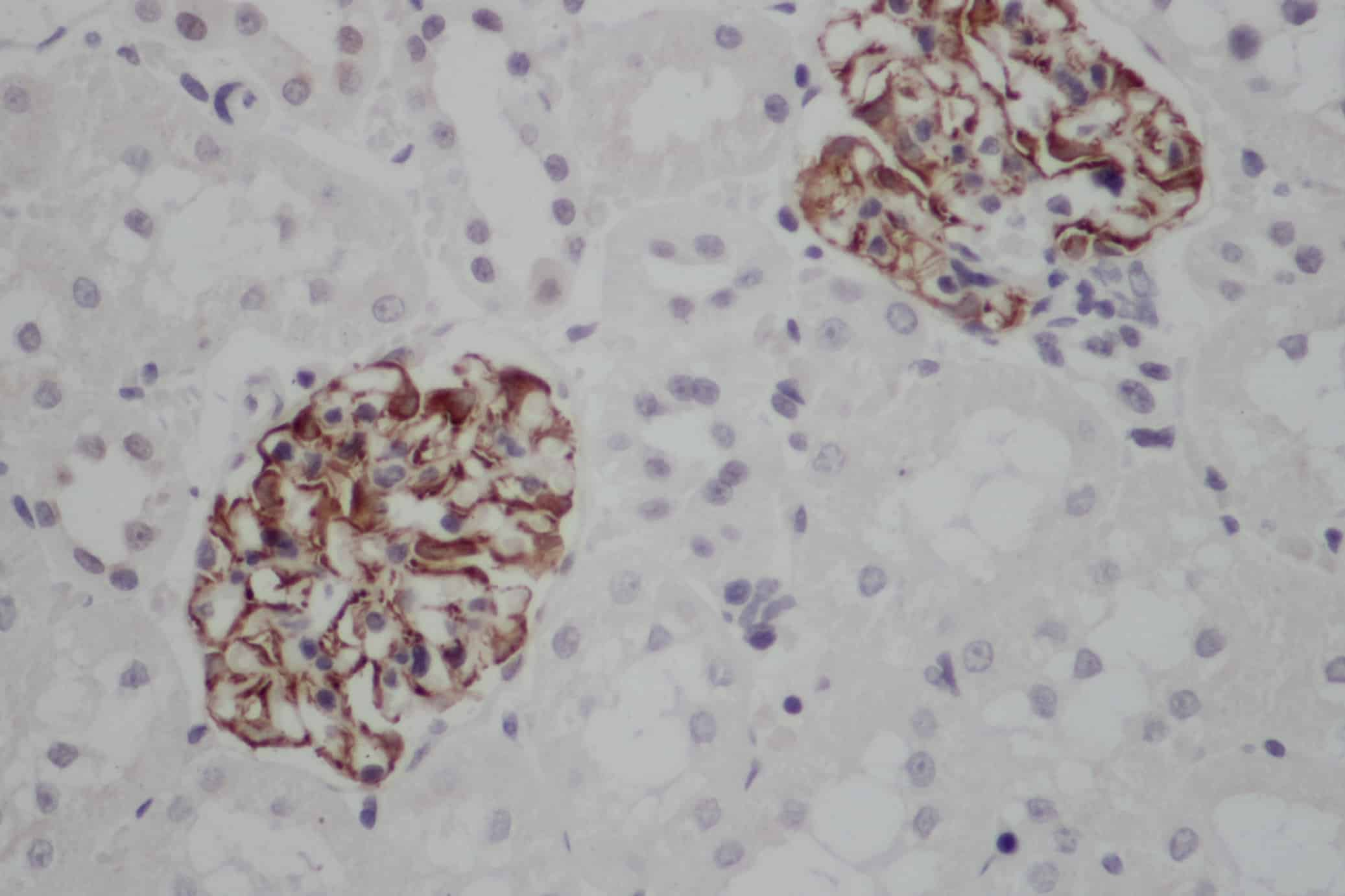 Immunohistochemistry of paraffin-embedded Human gasrtic cancer tissue using NES Polyclonal Antibody at dilution 1:30