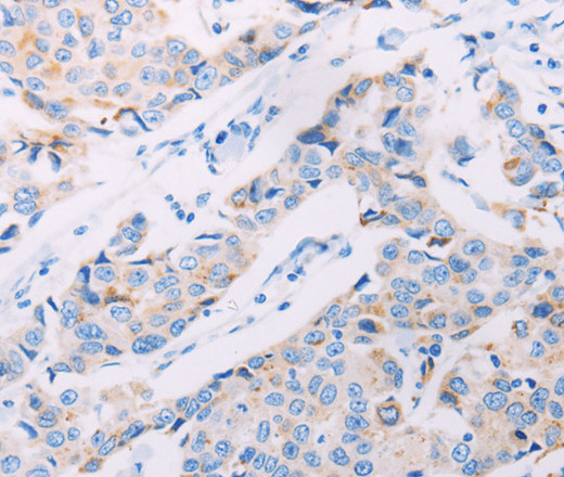 Immunohistochemistry of paraffin-embedded Human breast cancer tissue using AKT2 Polyclonal Antibody at dilution 1:70