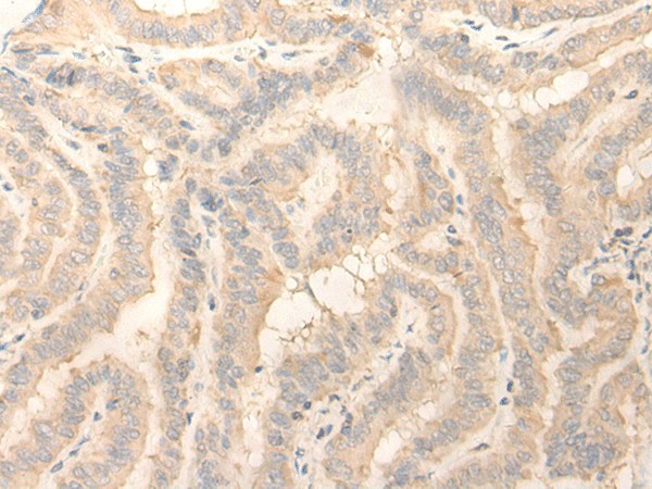 Immunohistochemistry of paraffin-embedded Human thyroid cancer tissue  using ERP27 Polyclonal Antibody at dilution of 1:25(?200)