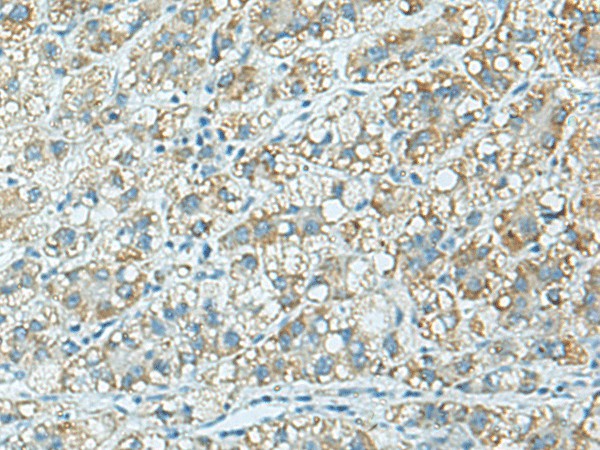 Immunohistochemistry of paraffin-embedded Human liver cancer tissue  using C3AR1 Polyclonal Antibody at dilution of 1:100(?200)