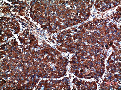 Immunohistochemistry of paraffin-embedded Human lung carcinoma tissue using AKT1 Monoclonal Antibody at dilution of 1:200.