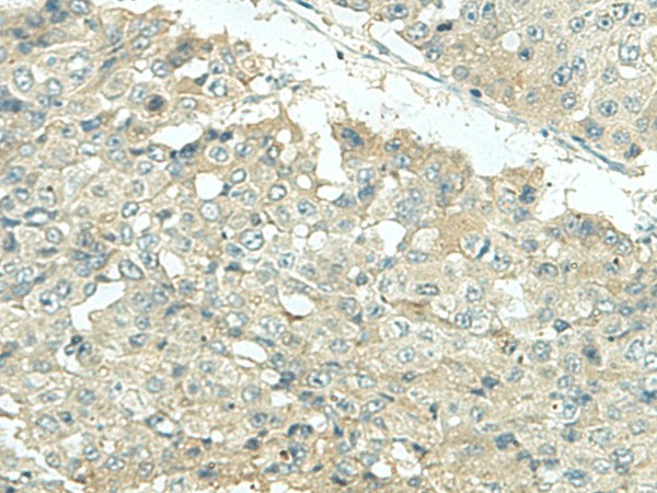 Immunohistochemistry of paraffin-embedded Human liver cancer tissue  using KIR2DL5A Polyclonal Antibody at dilution of 1:35(?200)