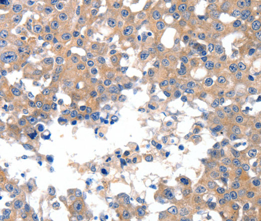 Immunohistochemistry of paraffin-embedded Human breast cancer using JNK1 Polyclonal Antibody at dilution of 1:50