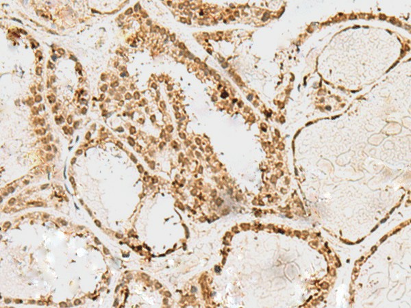 Immunohistochemistry of paraffin-embedded Human thyroid cancer tissue  using SNAPC1 Polyclonal Antibody at dilution of 1:60(?200)