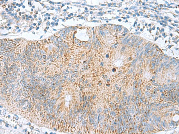 Immunohistochemistry of paraffin-embedded Human colorectal cancer tissue  using GCSH Polyclonal Antibody at dilution of 1:60(?200)